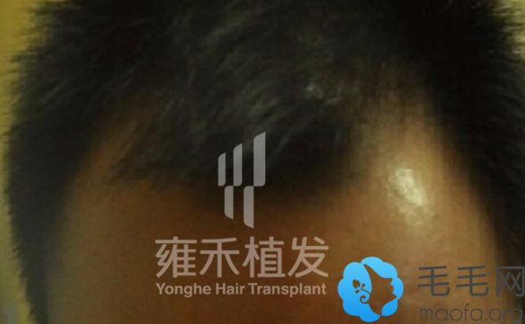北京雍禾植发前图片