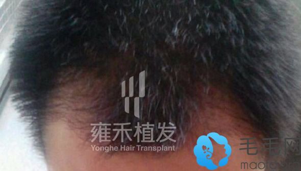 北京雍禾植发两个多月效果