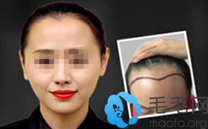 女性在南京植发际线案例效果对比图