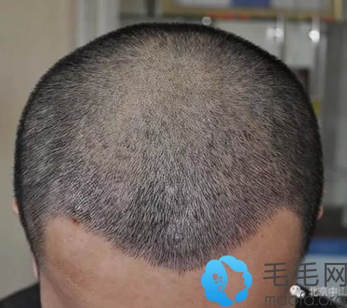 在北京中山植发6个月后头发已经变的很浓密了