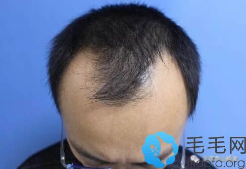 李先生在北京中山植发种植头发术后前照
