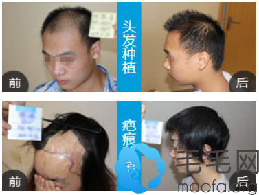 毛发移植医生韩岩头发种植案例和疤痕植发案例