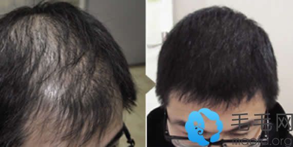 南京雍禾头发加密种植效果案例