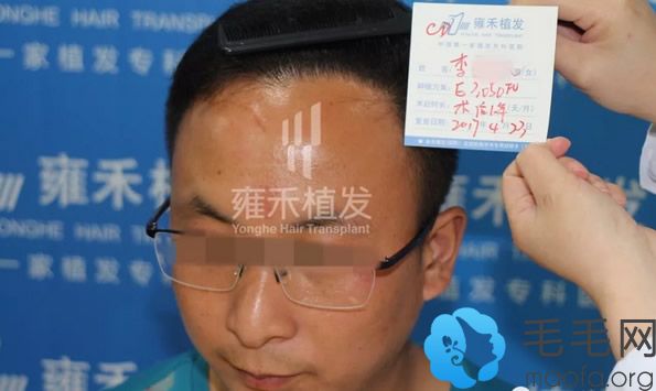 北京雍禾毛发移植一年效果图