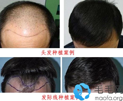 江苏省人民医院范卫新植发怎么样？看头发种植+发际线种植案例对比图
