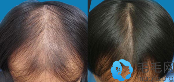 男性在重庆毛发医院做头发稀疏加密种植效果对比图