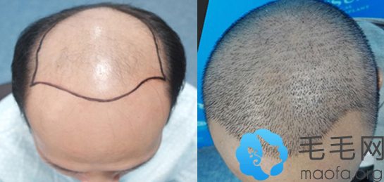 U型脱发男性在重庆东方植发做头发种植前后效果对比