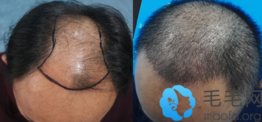 M型脱发男性在重庆东方毛发医院做发际线种植前后对比图
