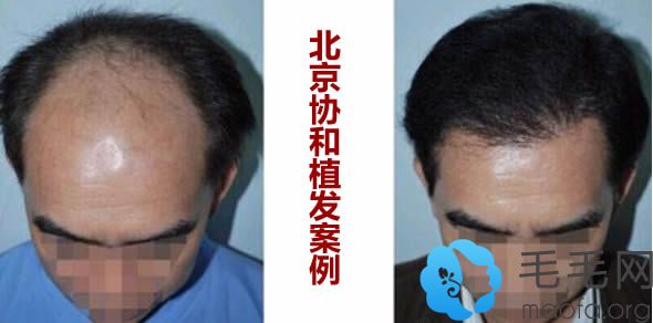 北京协和秃顶植发案例及前后对比效果