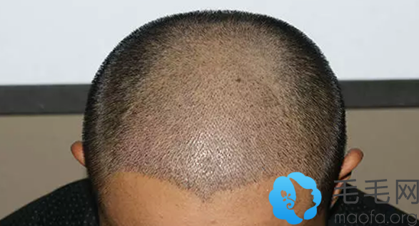 在北京协和医院做头发种植术后第8天恢复情况