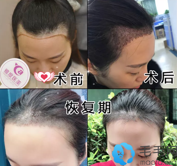 M字额头女生在广州雅度植发中心做发际线种植术前术后对比案例效果展示