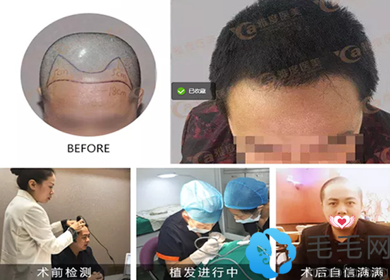 脱发男士在广州雅度植发中心做发际线种植过程及效果对比图