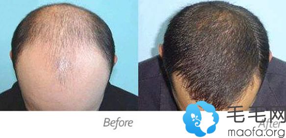 华美PDT头发种植前后效果对比图