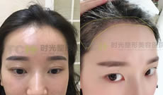看看重庆时光毛发移植医生杨杰给女士种植发际线的效果图