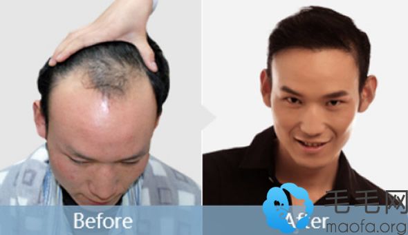 FUE-APL2.0无痕植发技术种植头发一年的恢复效果