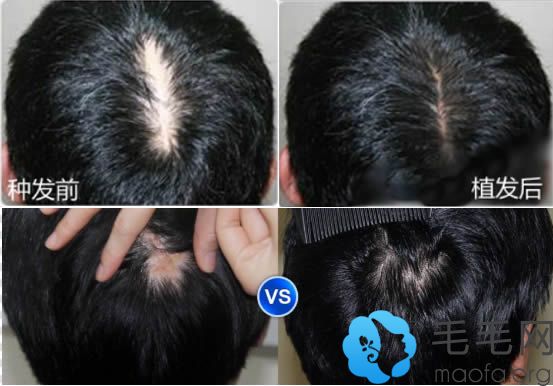 重庆西南医院王量疤痕植发前后对比效果图