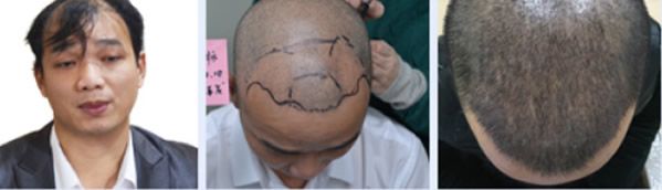 五级脱发在台州美莱种植头发三个月恢复效果图