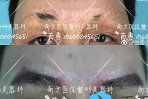 男士植眉案例:广州南方医院苗勇种植眉毛一年后效果图赏析