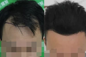 我被诊断为四级脱发，在上海新生花39860元种植了前额发际线