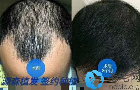 合肥源森冯亚伟种植发际线+头发加密效果案例