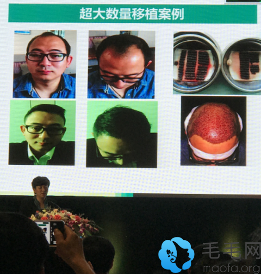 刘裴华医生在毛发学术研究会议上讲植发解案例