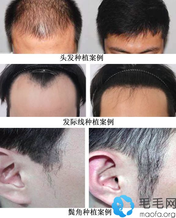 头发种植案例+发际线种植案例+鬓角种植案例