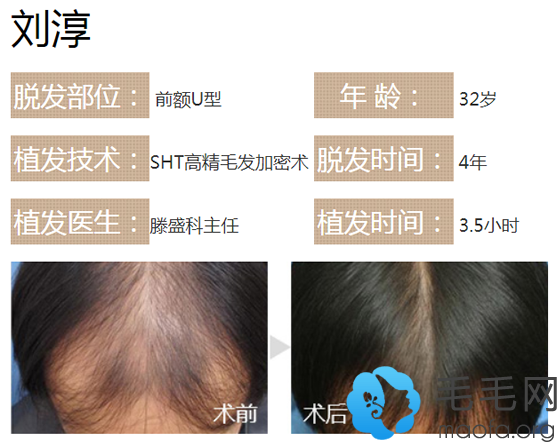 滕盛科为前额U型脱发男士头发加密种植案例前对比图