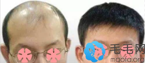 遗传秃顶植发前后对比效果