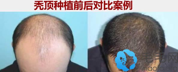 北京碧莲盛秃顶植发前后对比效果
