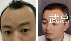 大家看王先生在武汉武总医院植发际线半年后 是32岁还是23岁