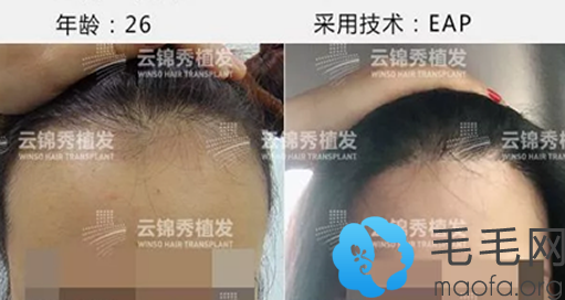 宁波云锦秀植发发际线种植案例对比图