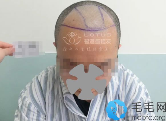 植发多久才有效果?上海碧莲盛种植发际线术后8个月案例反馈