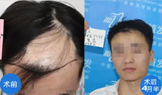 ​杨洲医生现在是合肥雍禾植发主任 这是他的疤痕植发案例