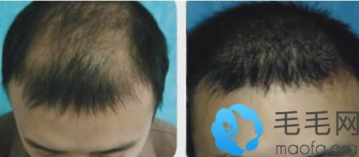 石家庄雍禾马医生头发稀疏加密植发案例及前后对比效果