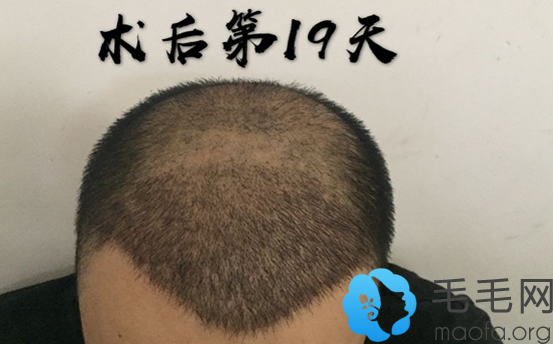 五级脱发男士在南宁科发源种植头发术后第19天效果图