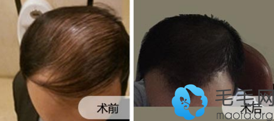 大面积脱发男士在重庆莱森植发做头发种植案例对比图