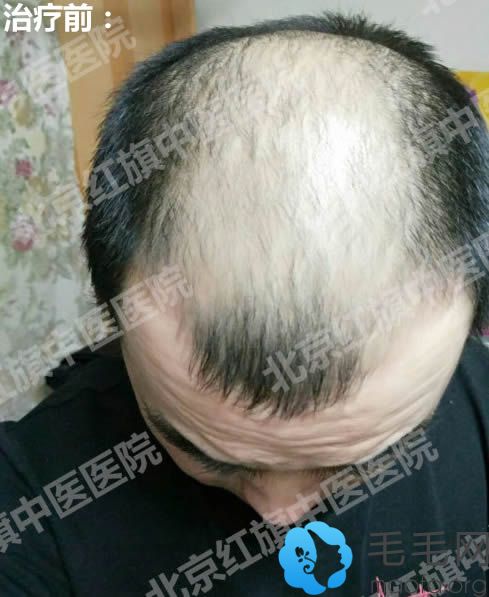脂溢性脱发怎么办?看我在北京红旗医院治疗脱发的30天效果