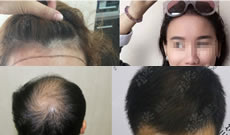 要想知道广州植德植发好不好 真人效果案例对比图就能证明