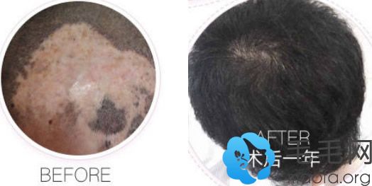 武汉五洲疤痕种植头发案例