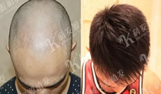 1年前他植发失败后选择在深圳科发源做了植发二次修复手术
