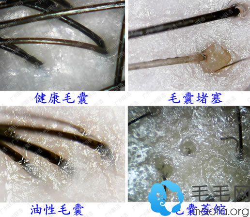 做过毛囊检测后,从毛囊检测结果来分析,正常的健康毛囊会生长出2-4根