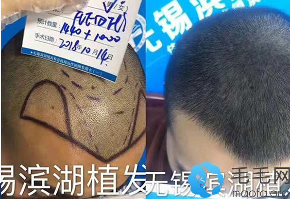 无锡滨湖潘冠豪主任发际线种植+头发加密两个月效果