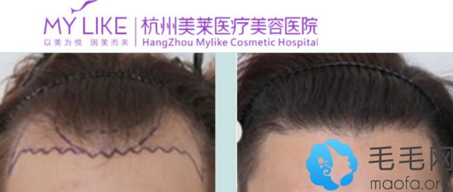 杭州美莱吴克威种植发际线案例及前后对比效果