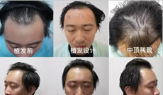 我种植发际线后 觉得上海AHS复毛植发林宜蓉的技术很赞