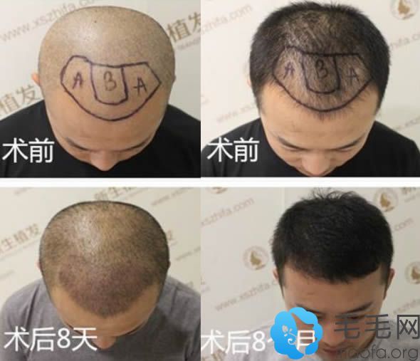 宁波新生金银磊医生M型脱发植发8个月恢复效果