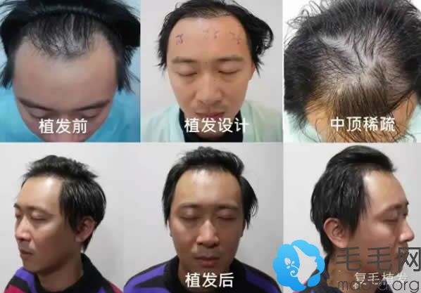 上海AHS复毛植发真人种植发际线+头发加密效果案例
