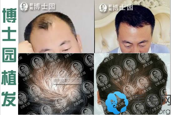 男士m型脱发及头顶加密种植案例及一年后恢复效果