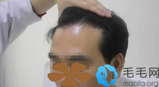 在上海碧莲盛种植头发10个月恢复效果