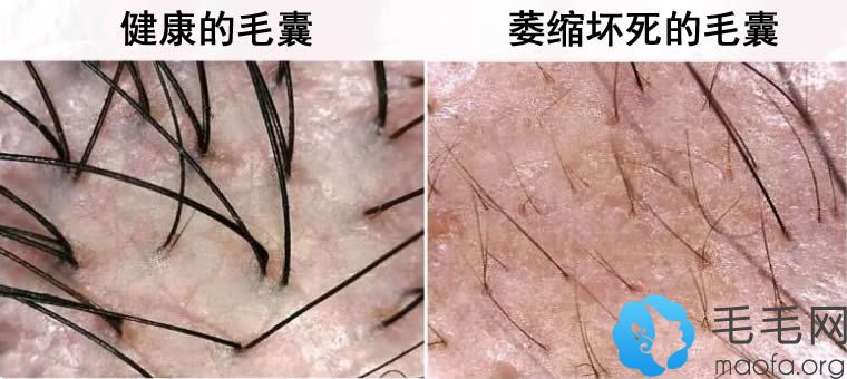 请看毛囊坏死的症状及图片 - 脱发知识 - 毛毛网