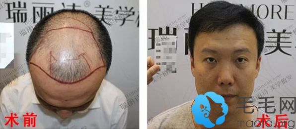 五级脱发种植4000单位毛囊够吗 瞅瞅秃顶植发案例_杭州植发植发案例 - 毛毛网
